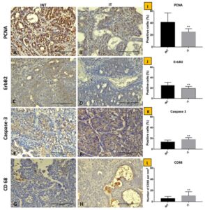 Immunostaining of breast adenocarcinoma tissue sections after ECCT treatment.